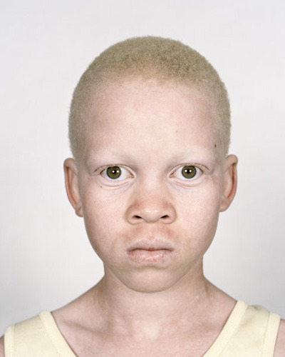 Альбинизм рецессивный признак, то есть, чтобы родился альбинос, оба